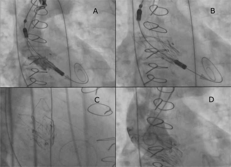 Use of Boston Accurate Neo transcatheter aortic valve for valve-in-valve procedure in 82-year-old patient with Medtronic Mosaic bioprosthesis.