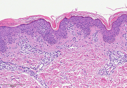 Pityriasis rosea and pityriasis rosea-like eruption after anti-SARS-CoV-2 vaccination: a report of five cases and review of the literature.