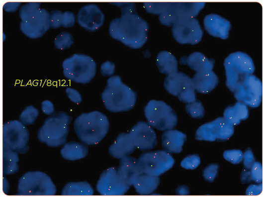 Using Pleomorphic Adenoma Gene 1 (<i>PLAG1</i>) to Distinguish Carcinoma of the Parotid Gland From Primary Lung Cancer: A Case Study.