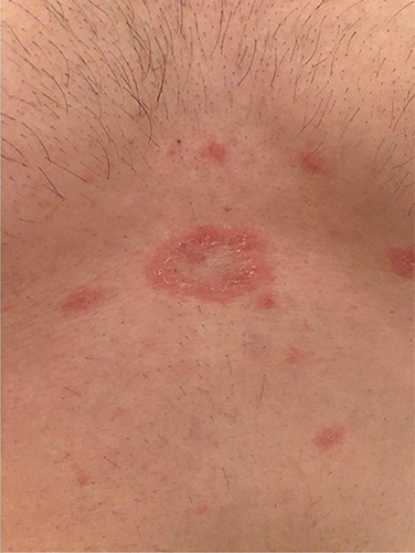 Pityriasis rosea and pityriasis rosea-like eruption after anti-SARS-CoV-2 vaccination: a report of five cases and review of the literature.