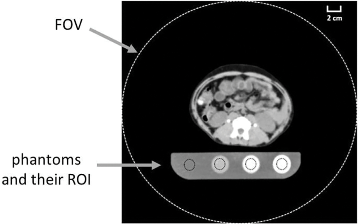 Measurement of renal cortical fibrosis by CT scan