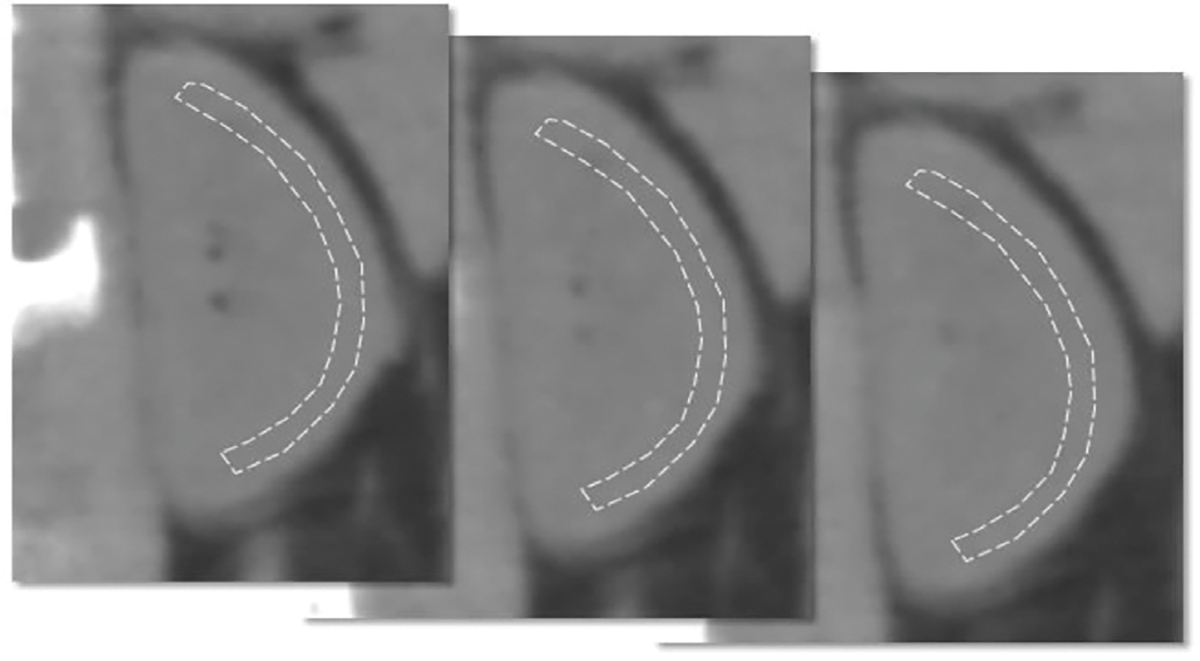 Measurement of renal cortical fibrosis by CT scan