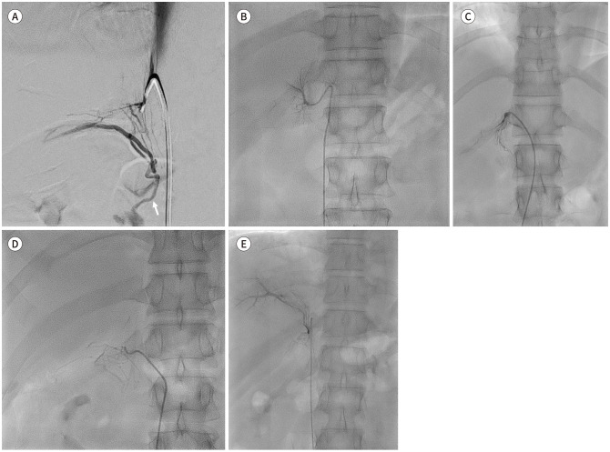 [Adrenal Vein Sampling in Primary Aldosteronism: A Pictorial Essay for Optimal Left-Side Sampling].