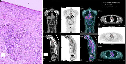 Maculopapular sarcoidosis: the importance of skin signs.