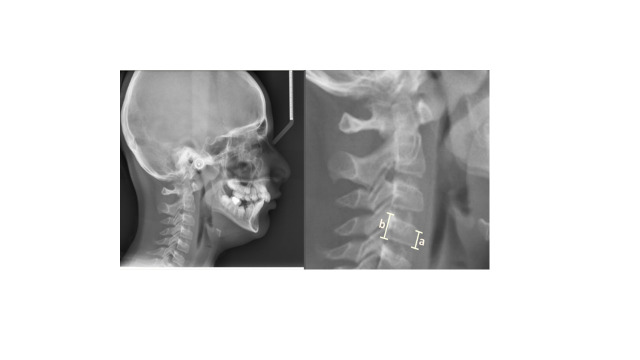 Comparison of Dental and Skeletal Age Estimating Methods in Children.