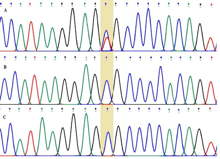 A de novo TINF2, R282C Mutation in a Case of Dyskeratosis Congenital Founded by Next-Generation Sequencing.