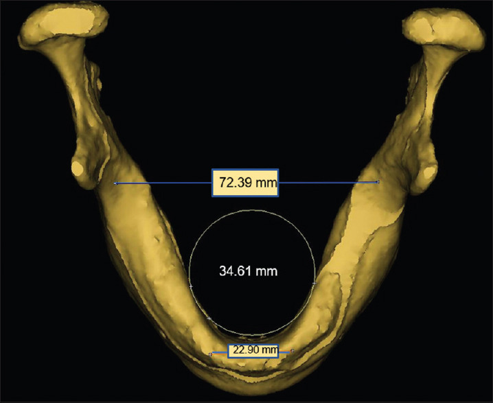 Comparison between all-on-four and all-on-six treatment concepts on stress distribution for full-mouth rehabilitation using three-dimensional finite element analysis: A biomechanical study.