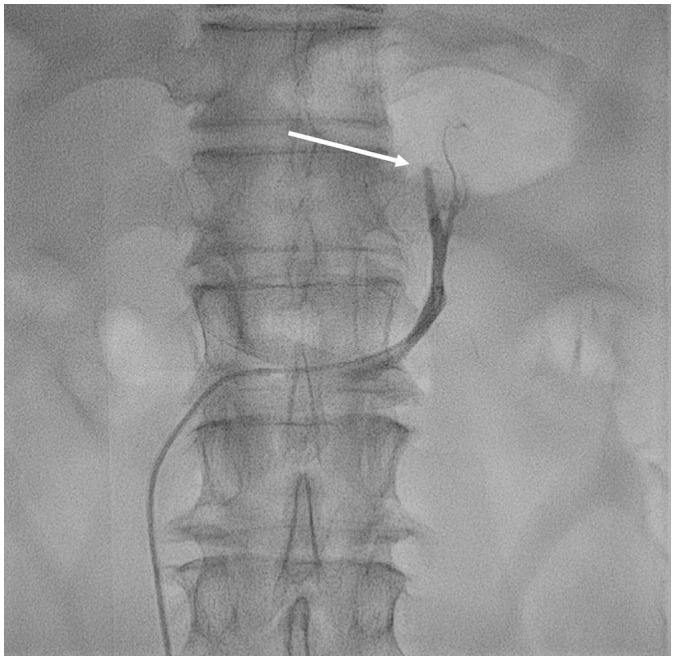 [Adrenal Vein Sampling in Primary Aldosteronism: A Pictorial Essay for Optimal Left-Side Sampling].