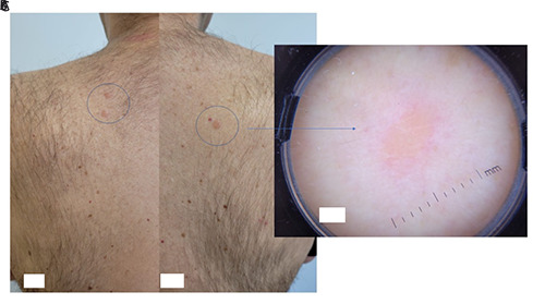 Maculopapular sarcoidosis: the importance of skin signs.