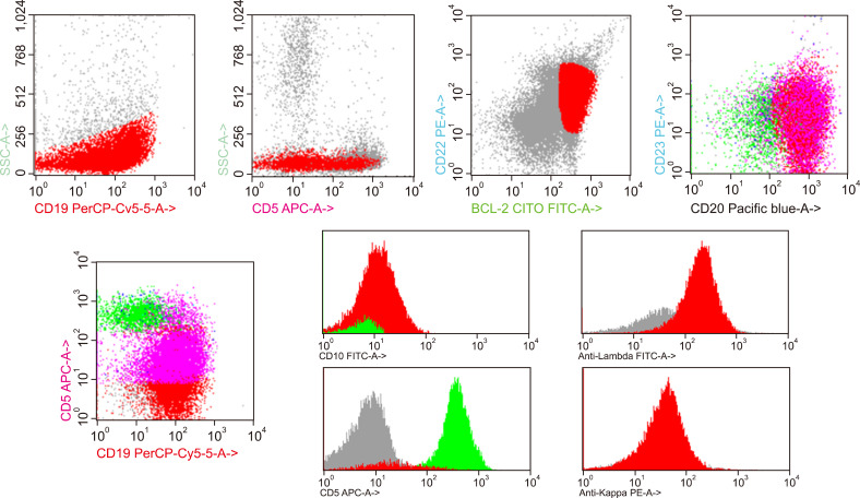 CD5+ follicular lymphoma rapidly transformed to high-grade B-cell lymphoma with double-hit: from <i>BCL2</i> to <i>MYC</i> disruption.