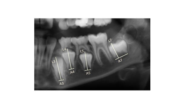 Comparison of Dental and Skeletal Age Estimating Methods in Children.