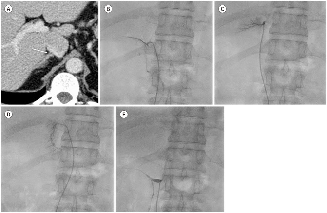 [Adrenal Vein Sampling in Primary Aldosteronism: A Pictorial Essay for Optimal Left-Side Sampling].