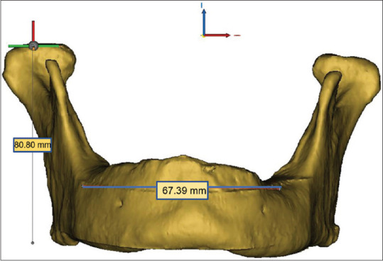 Comparison between all-on-four and all-on-six treatment concepts on stress distribution for full-mouth rehabilitation using three-dimensional finite element analysis: A biomechanical study.