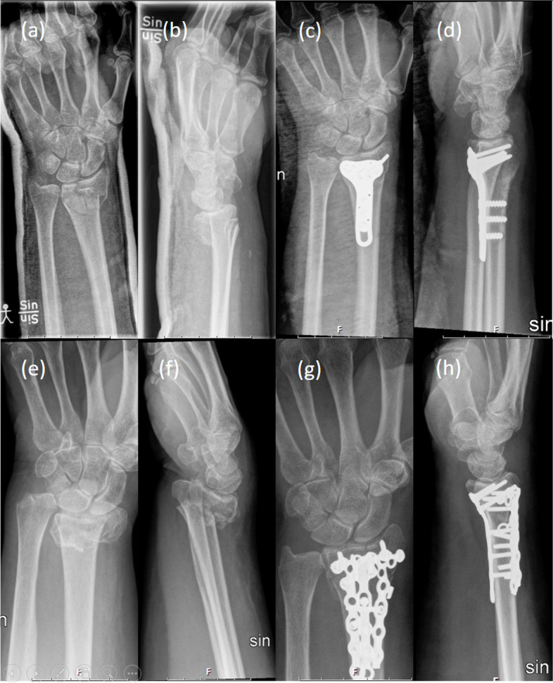 Pulp-to-palm distance after plate fixation of a distal radius fracture corresponds to functional outcome.