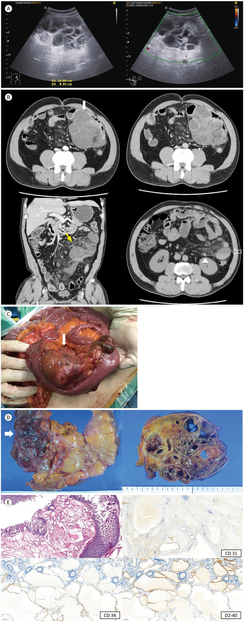 Rare Case of Large Hemolymphangioma in the Small Bowel Mesentery: A Case Report.