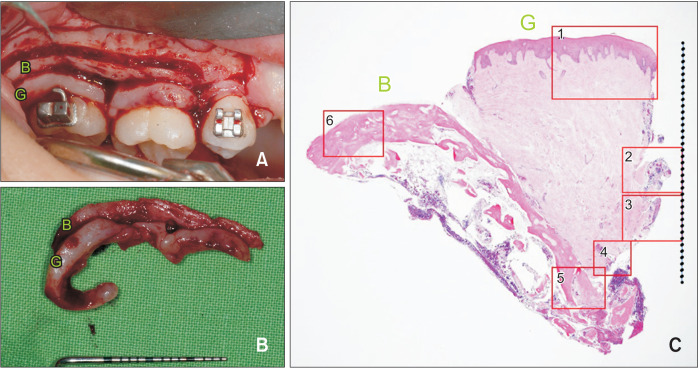 Histological analysis on tissues around orthodontically intruded maxillary molars using temporary anchorage devices: A case report.