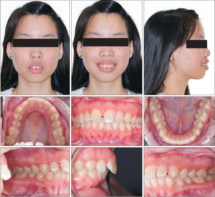 Histological analysis on tissues around orthodontically intruded maxillary molars using temporary anchorage devices: A case report.