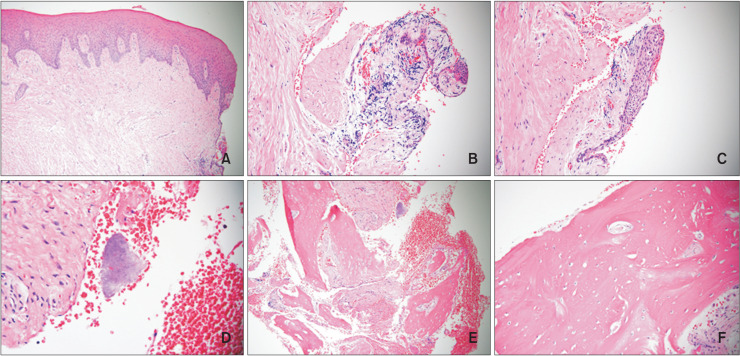 Histological analysis on tissues around orthodontically intruded maxillary molars using temporary anchorage devices: A case report.