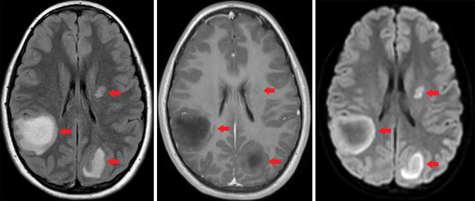 Acute disseminated encephalomyelitis (ADEM)-like illness in a pediatric patient following COVID-19 vaccination.