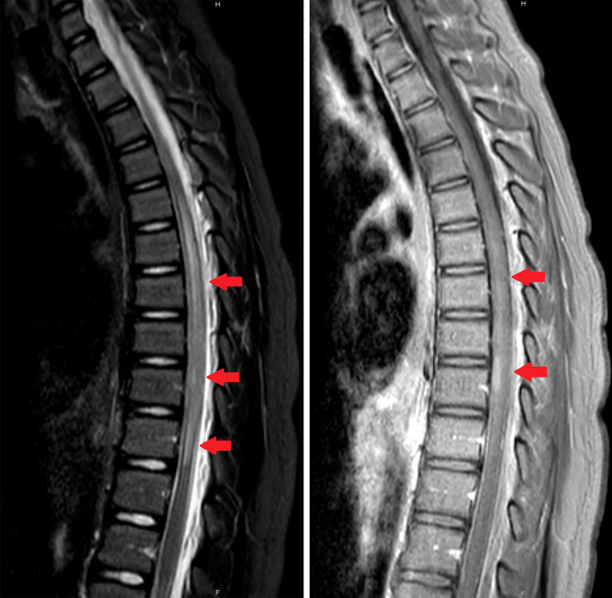 Acute disseminated encephalomyelitis (ADEM)-like illness in a pediatric patient following COVID-19 vaccination.