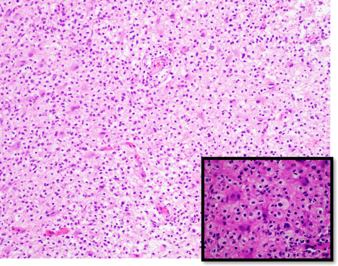 Acute disseminated encephalomyelitis (ADEM)-like illness in a pediatric patient following COVID-19 vaccination.