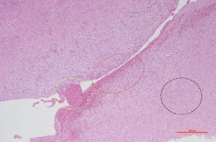 Surgical Excision for Refractory Ischiogluteal Bursitis: A Consecutive Case Series of 21 Patients.