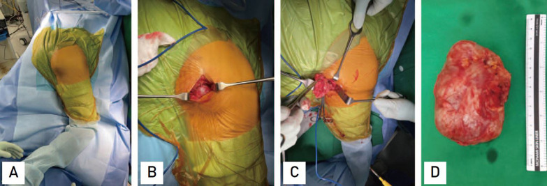 Surgical Excision for Refractory Ischiogluteal Bursitis: A Consecutive Case Series of 21 Patients.