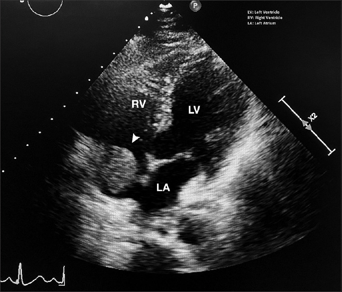 Unusual complication of central venous catheter detected on contrast-enhanced EUS (with video).