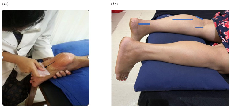 Comparative Effectiveness of Gua Sha, Cryostretch, and Positional Release Technique on Tenderness and Function in Subjects with Plantar Fasciitis: a Randomized Clinical Trial.