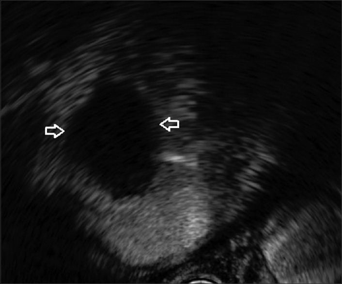 Unusual complication of central venous catheter detected on contrast-enhanced EUS (with video).