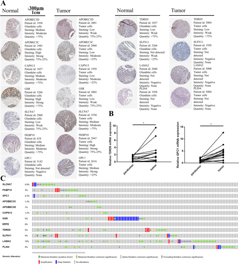 Development and validation of an RBP gene signature for prognosis prediction in colorectal cancer based on WGCNA.