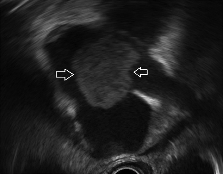 Unusual complication of central venous catheter detected on contrast-enhanced EUS (with video).