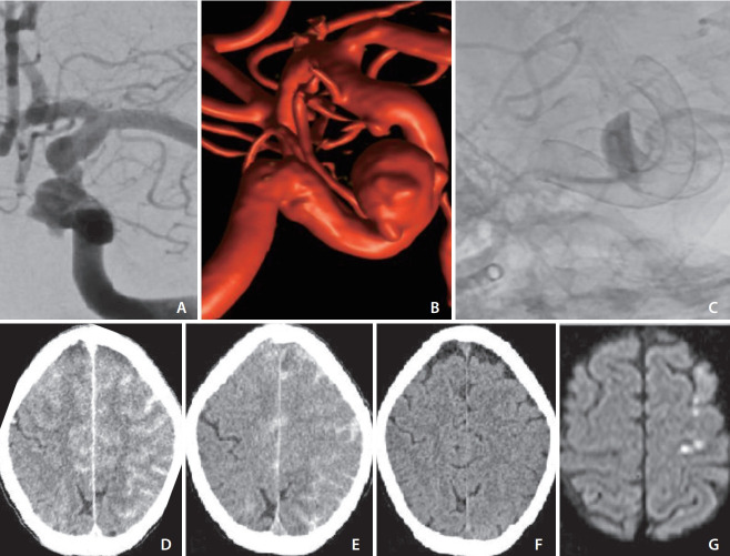 Fully Reversible Contrast-Induced Encephalopathy Mimicking Stroke after Flow Diverter Treatment of Carotid Cave Aneurysm.