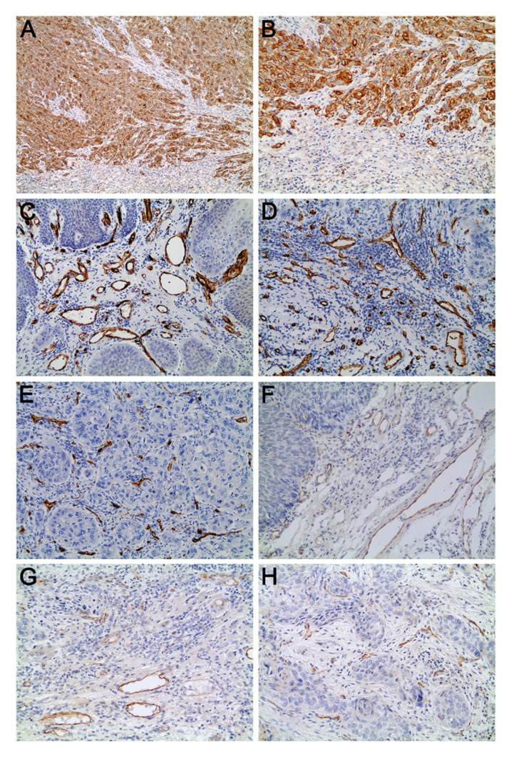 Microvascular density and tumor budding in oral squamous cell carcinoma.