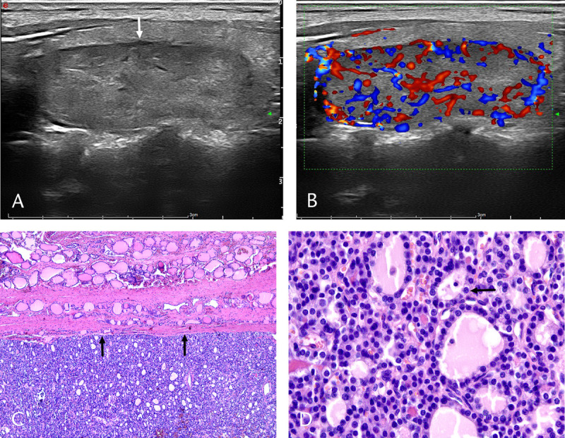 Clinical and Sonographic Features of Noninvasive Follicular Thyroid Neoplasm With Papillary-Like Nuclear Features: A Retrospective Study.