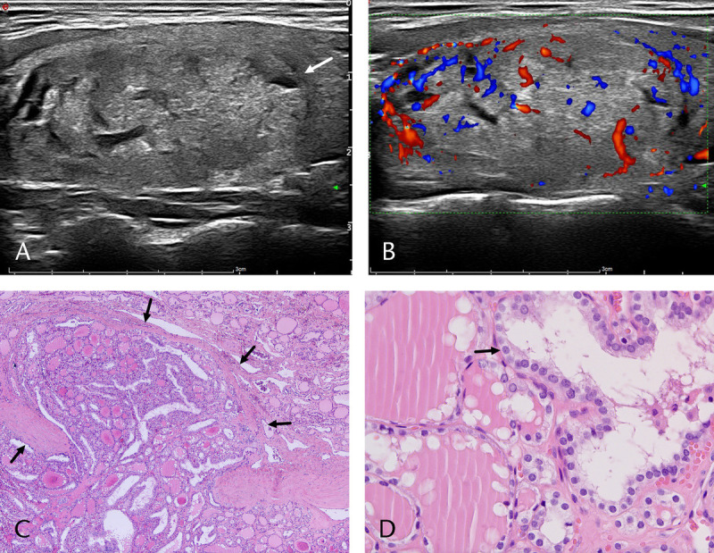 Clinical and Sonographic Features of Noninvasive Follicular Thyroid Neoplasm With Papillary-Like Nuclear Features: A Retrospective Study.