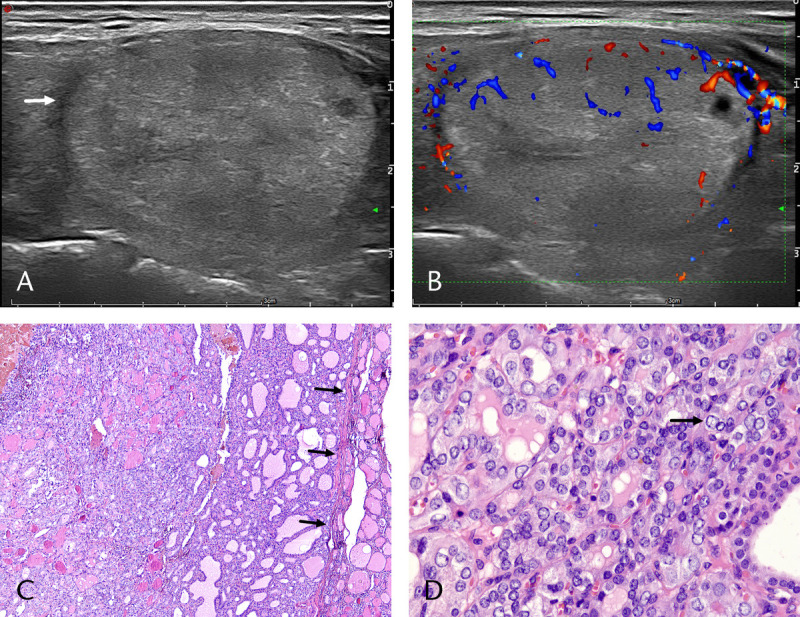 Clinical and Sonographic Features of Noninvasive Follicular Thyroid Neoplasm With Papillary-Like Nuclear Features: A Retrospective Study.