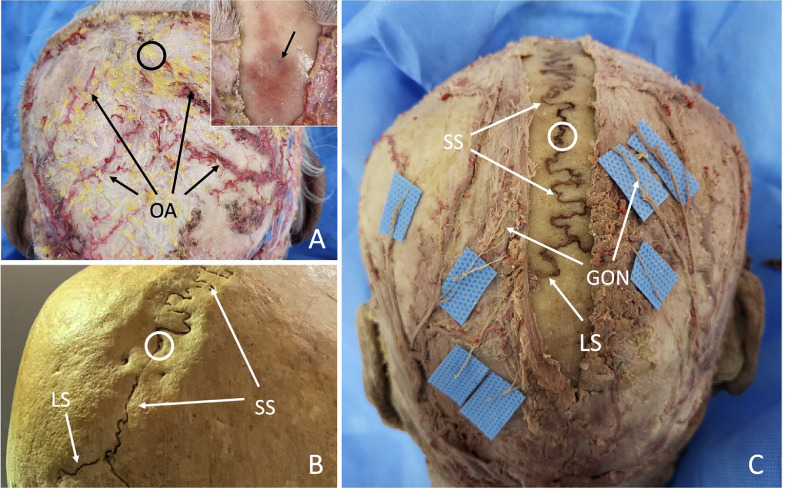 Anatomical features of the GV20 acupoint