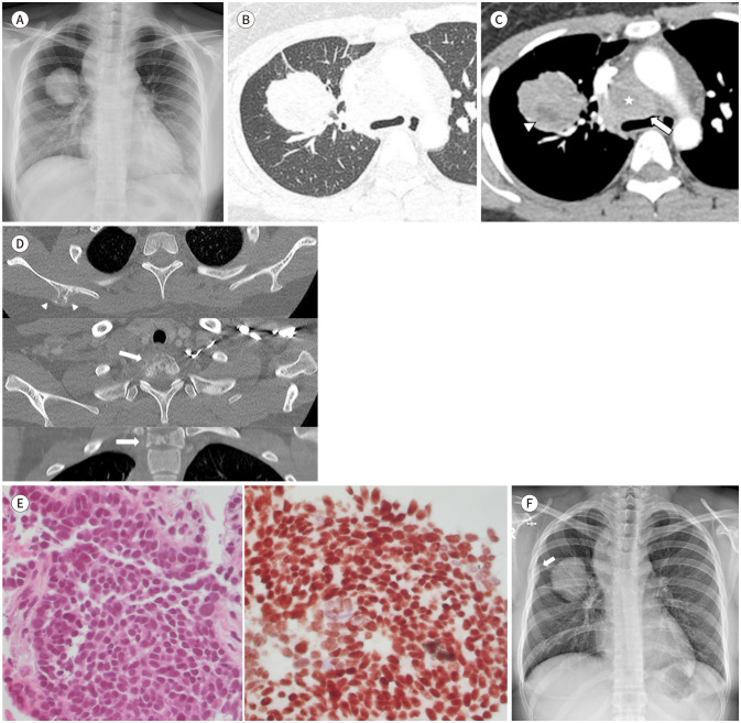 [Radiologic Manifestations of Pulmonary Nuclear Protein in Testis Midline Carcinoma: A Case Report].