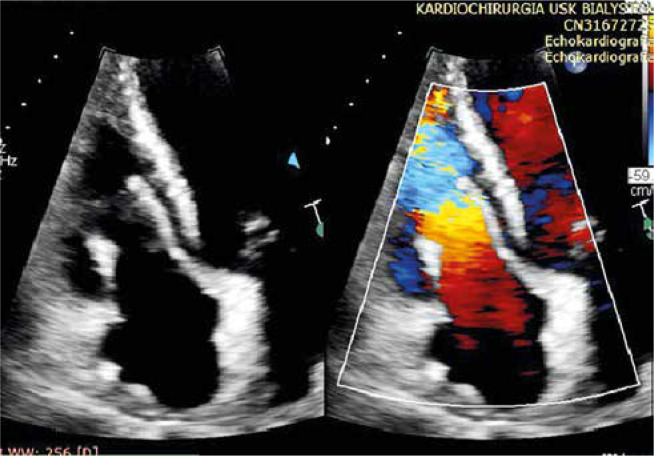 Infective endocarditis of the tricuspid valve. Surgical treatment with pericardial cylinder implantation.