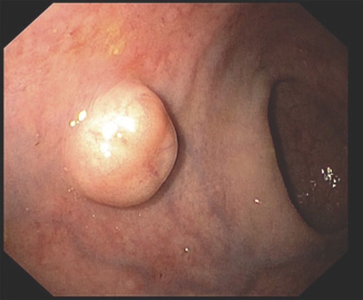 Cap-Assisted Endoscopic Mucosal Resection for Rectal Neuroendocrine Tumors: An Effective Option.