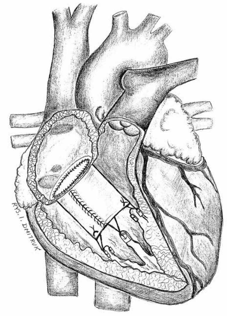 Infective endocarditis of the tricuspid valve. Surgical treatment with pericardial cylinder implantation.