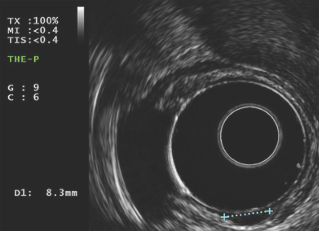 Cap-Assisted Endoscopic Mucosal Resection for Rectal Neuroendocrine Tumors: An Effective Option.