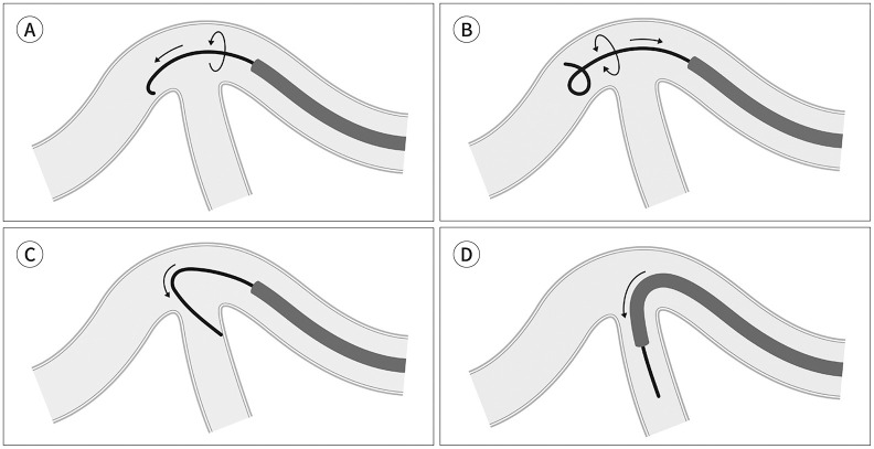 Folded-Loop Guidewire Remodeling Technique: Catheterizing Markedly Angulated Branches during Intravascular Embolization.