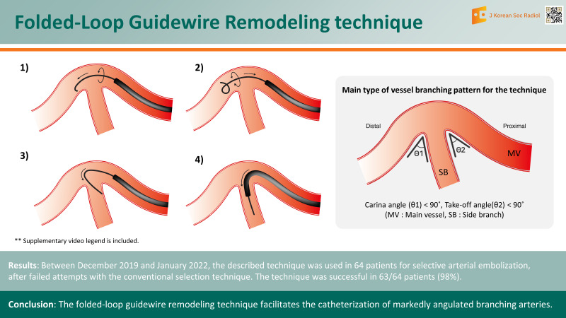 Folded-Loop Guidewire Remodeling Technique: Catheterizing Markedly Angulated Branches during Intravascular Embolization.