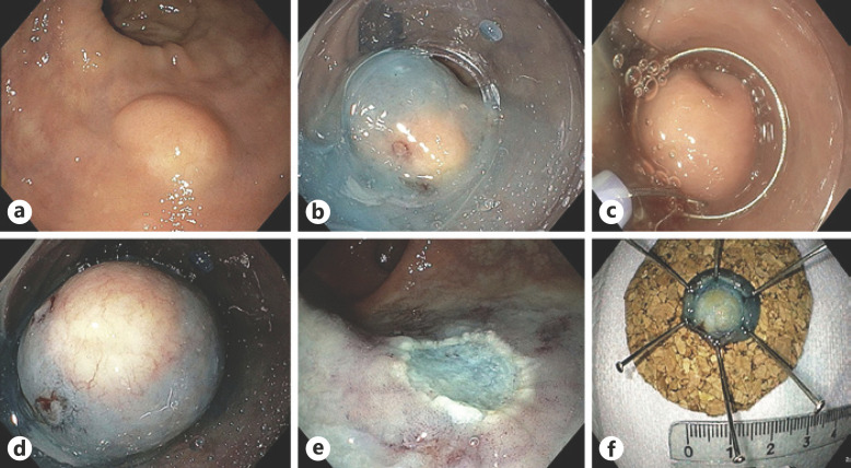 Cap-Assisted Endoscopic Mucosal Resection for Rectal Neuroendocrine Tumors: An Effective Option.