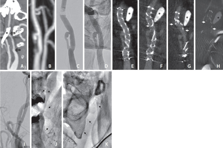 Fracture of a Flow Diverter in the Cervical Internal Carotid Artery Due to Eagle Syndrome.