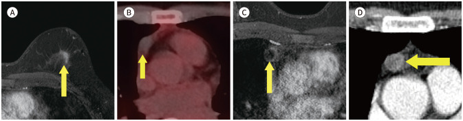 Incidental Extramammary Findings on Preoperative Breast MRI in Breast Cancer Patients: A Pictorial Essay.