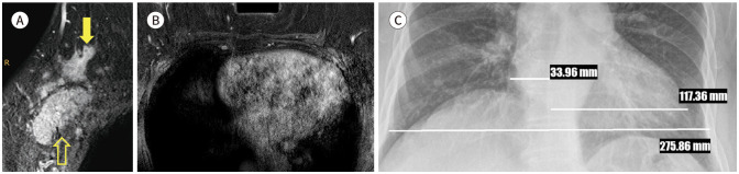 Incidental Extramammary Findings on Preoperative Breast MRI in Breast Cancer Patients: A Pictorial Essay.