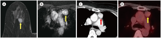 Incidental Extramammary Findings on Preoperative Breast MRI in Breast Cancer Patients: A Pictorial Essay.